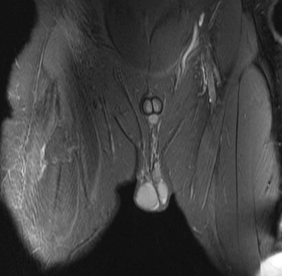 Figure 1 for case rectus femoris indirect head proximal myotendinous junction tear with hematoma( RID2698 )